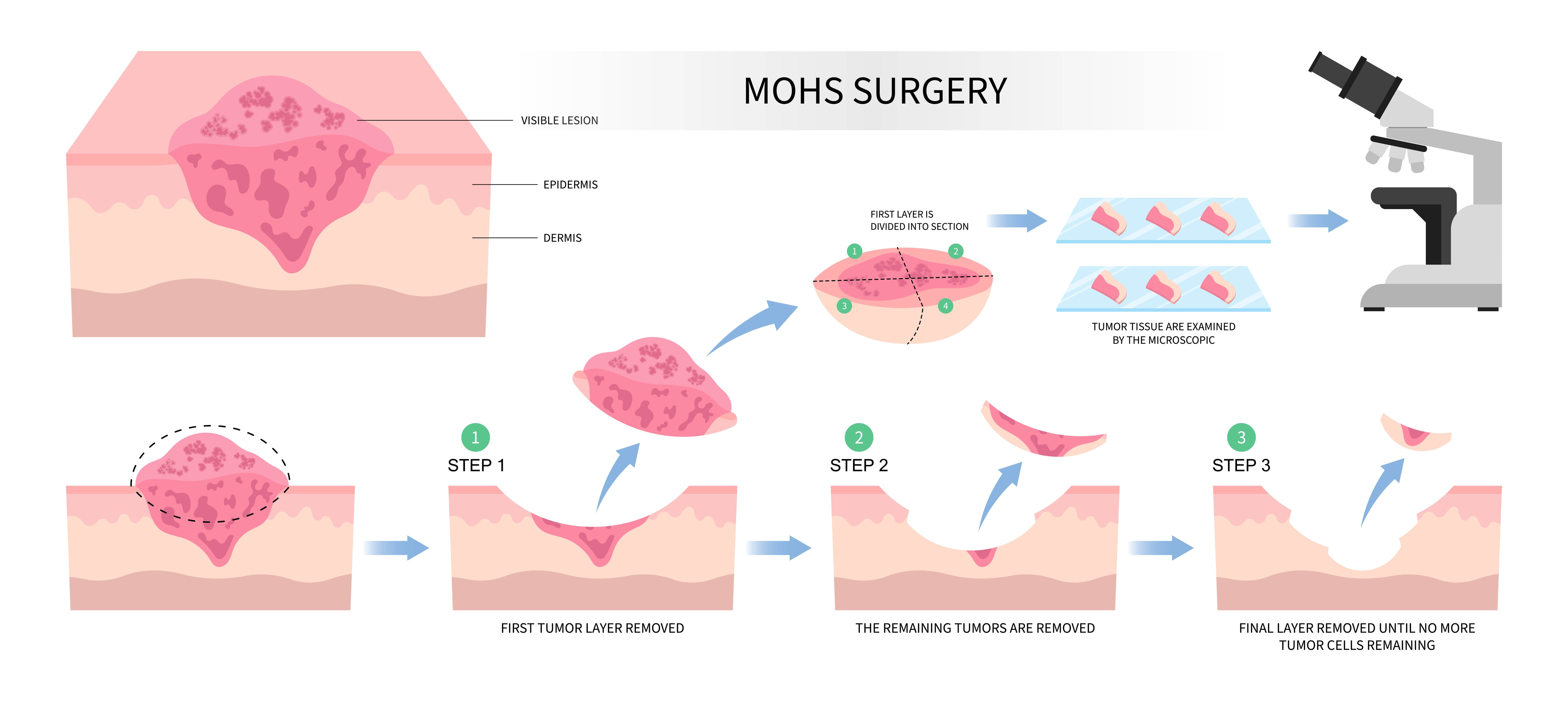 Mohs Surgery Process Diagram